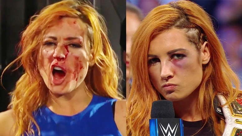 Becky Lynch Bleeding Broken Face Injured 2018