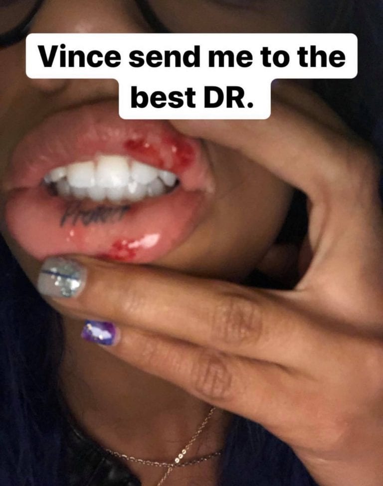 Sasha Banks Lip Busted Open