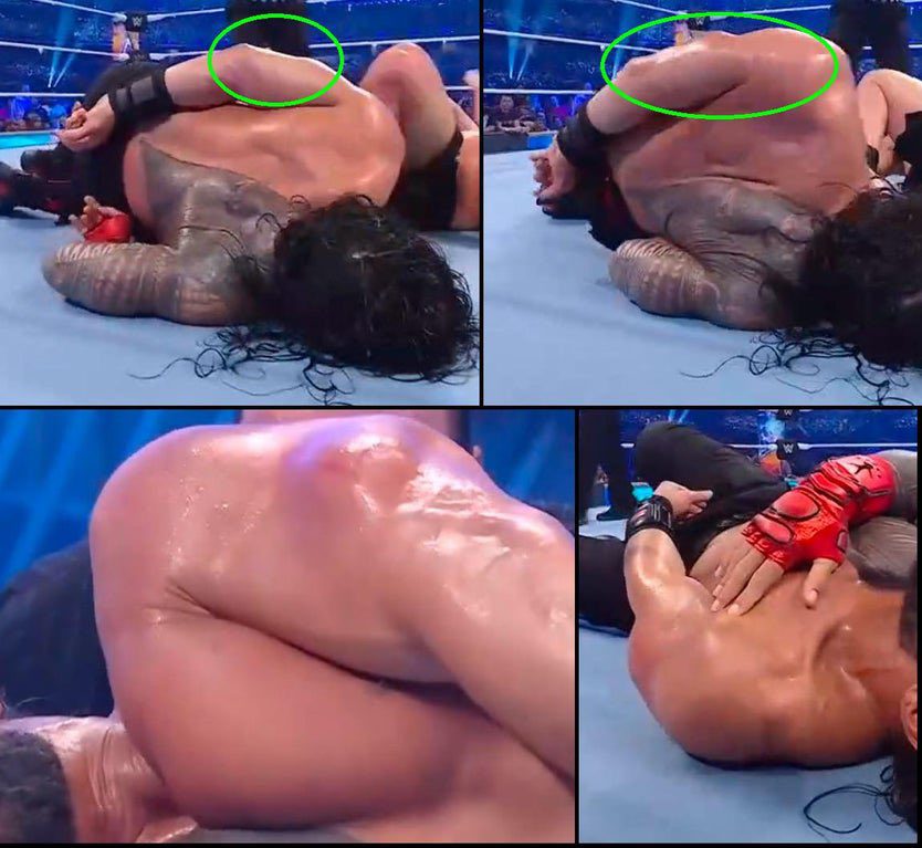 Roman Reigns WrestleMania 38 Injury