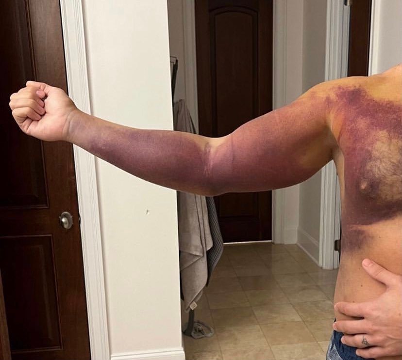 Cody Rhodes Posts An Updated Photo Of His Injury Chest Pec Tear
