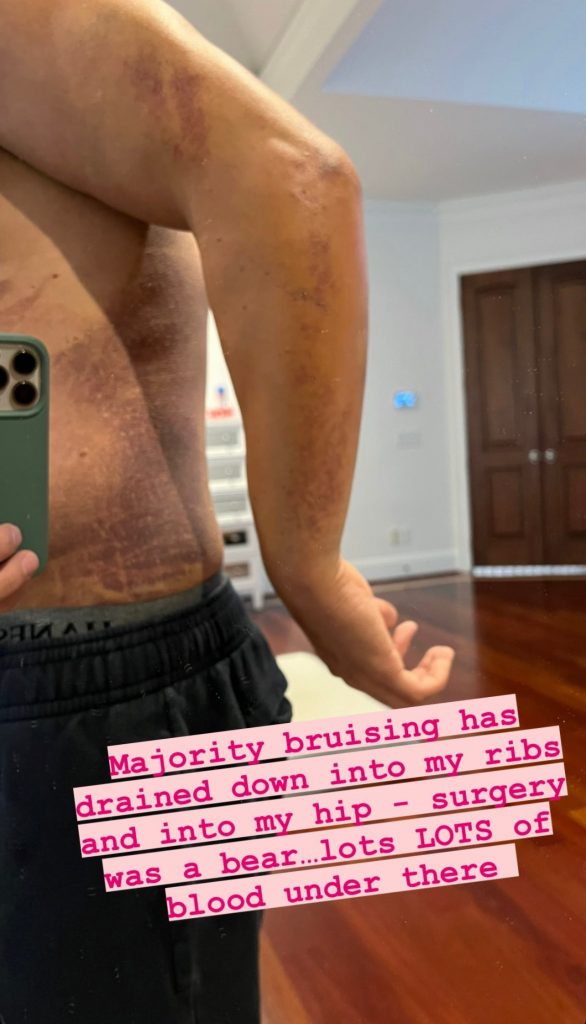 Pec Tear Bruising Drains Down To Ribs & Hips Of Cody Rhodes