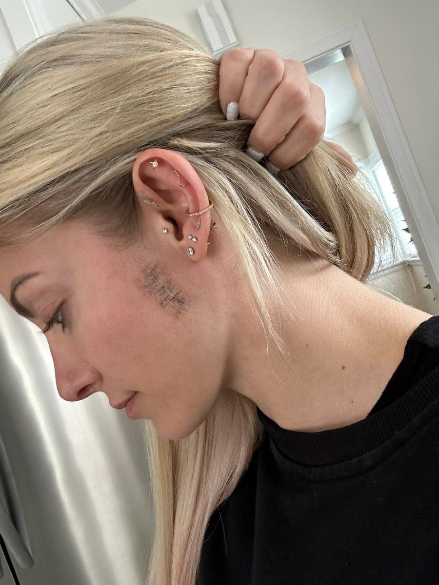 Alexa Bliss Skin Cancer Surgery Stitches