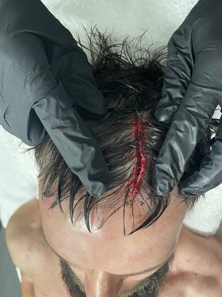Finn Balor Head Cut Wound Hell In A Cell WrestleMania 39