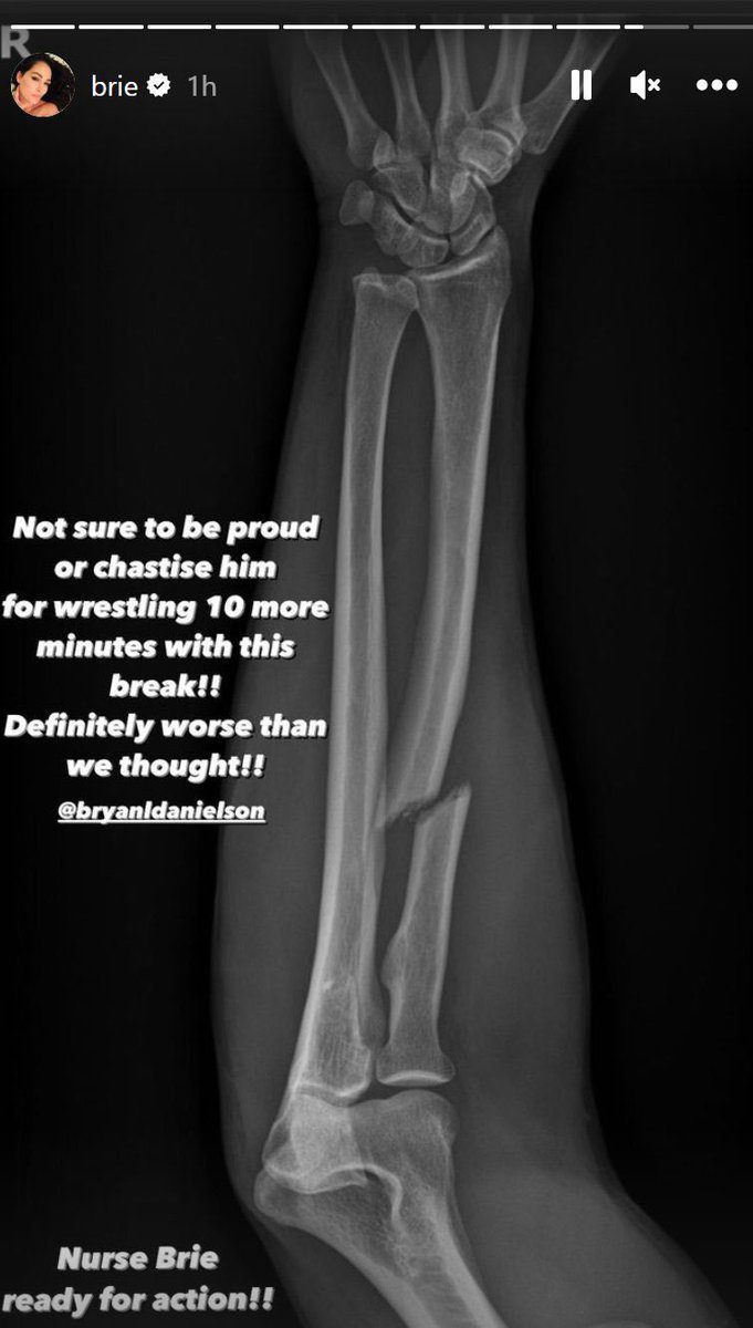 Daniel Bryan Danielson Broken Forarm X-Ray AEW x NJPW Forbidden Door 2023 Injury