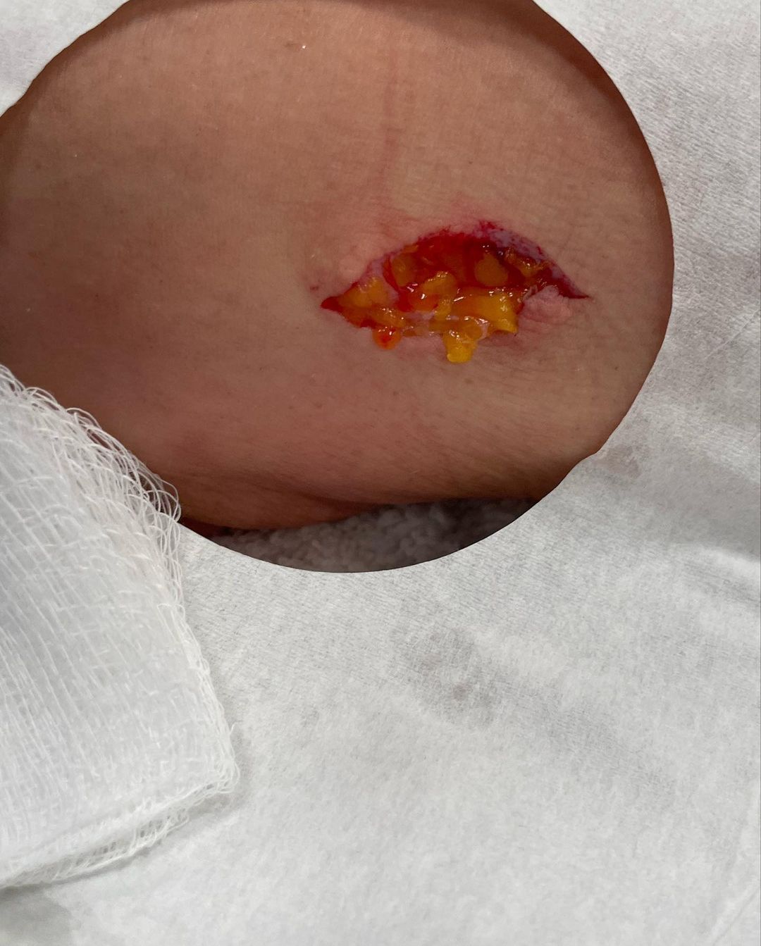 Becky Lynch 11 Stitches Laceration On Arm WWE NXT No Mercy 2023