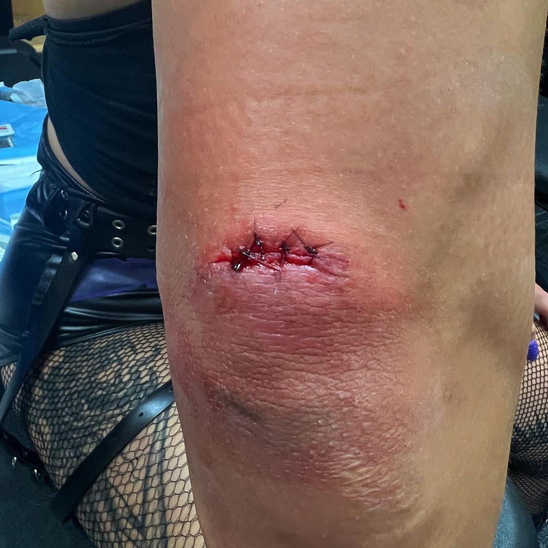 Rhea Ripley Elbow Stitches