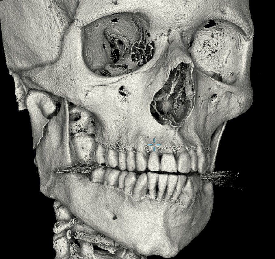 AEW wrestler Anthony Henry broken jaw