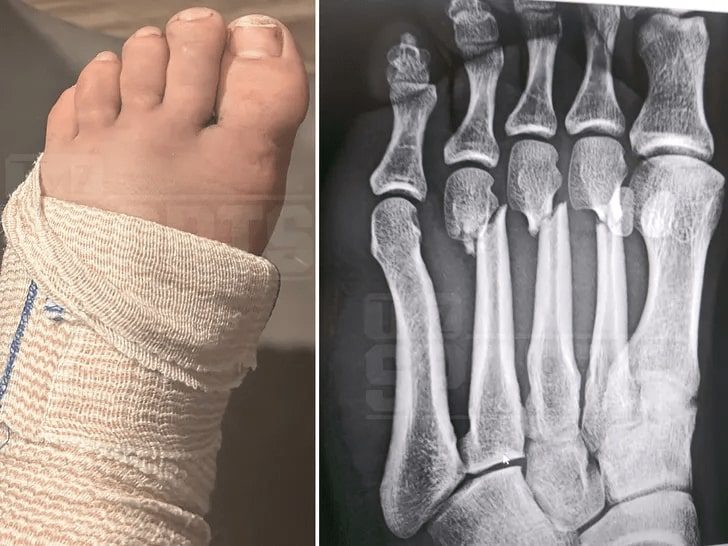Darby Allin Broken Foot AEW Dynamite Big Business 2024