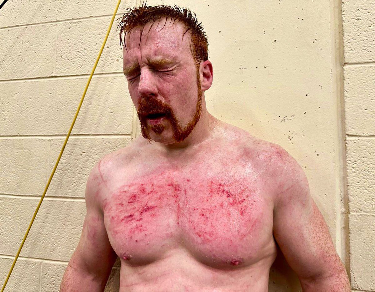 Sheamus Chest Bruising Red After WWE RAW King Of The Ring 2024 Tournament Match Against Gunther Walter