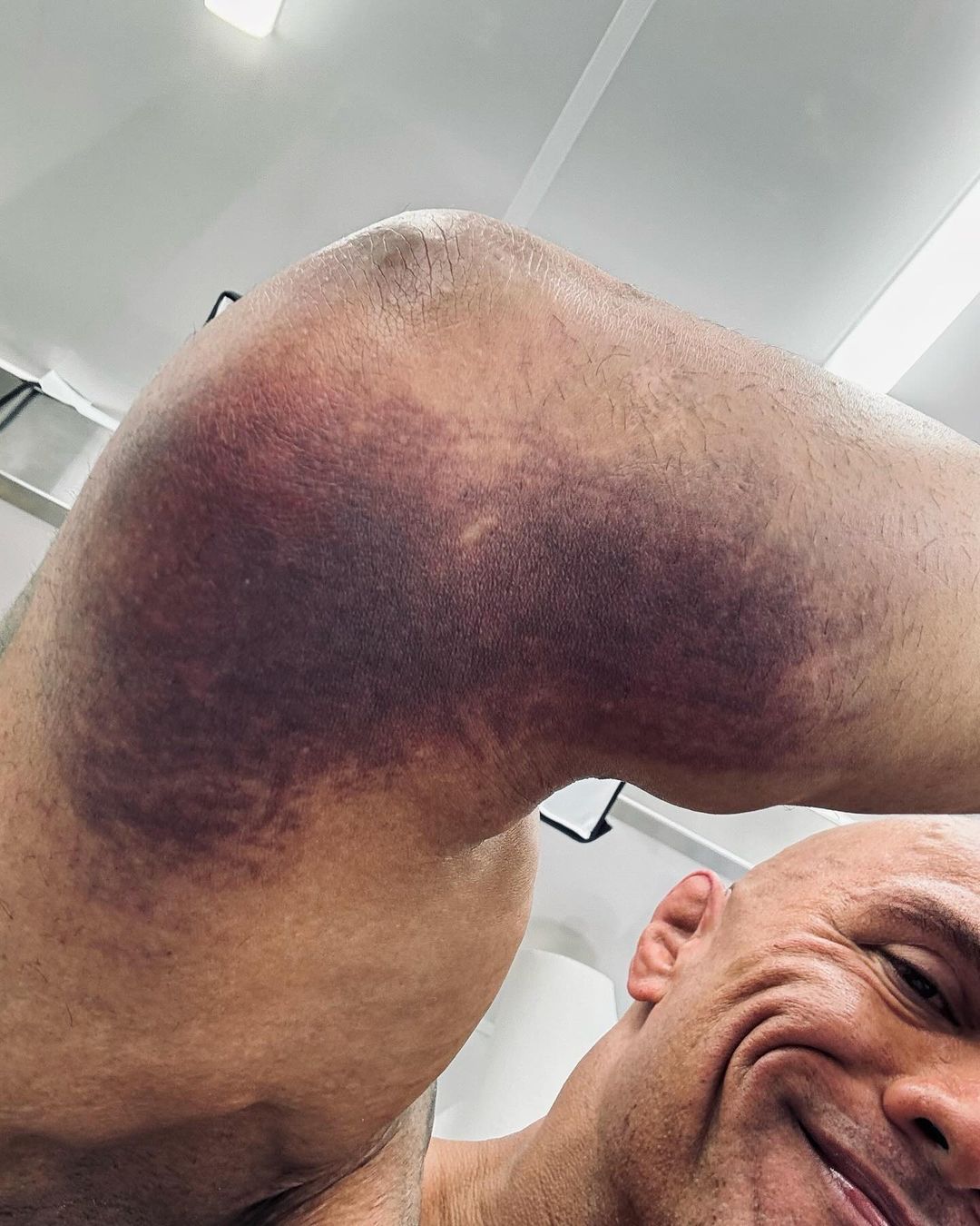 The Rock Dwayne Johnson Elbow Injury Ruptured Bursa Sac June 2024