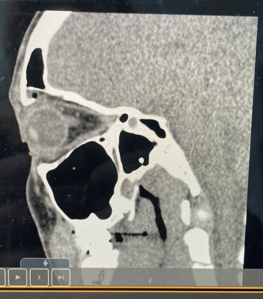 Rhea Ripley fractured right orbital socket X-ray - 2
