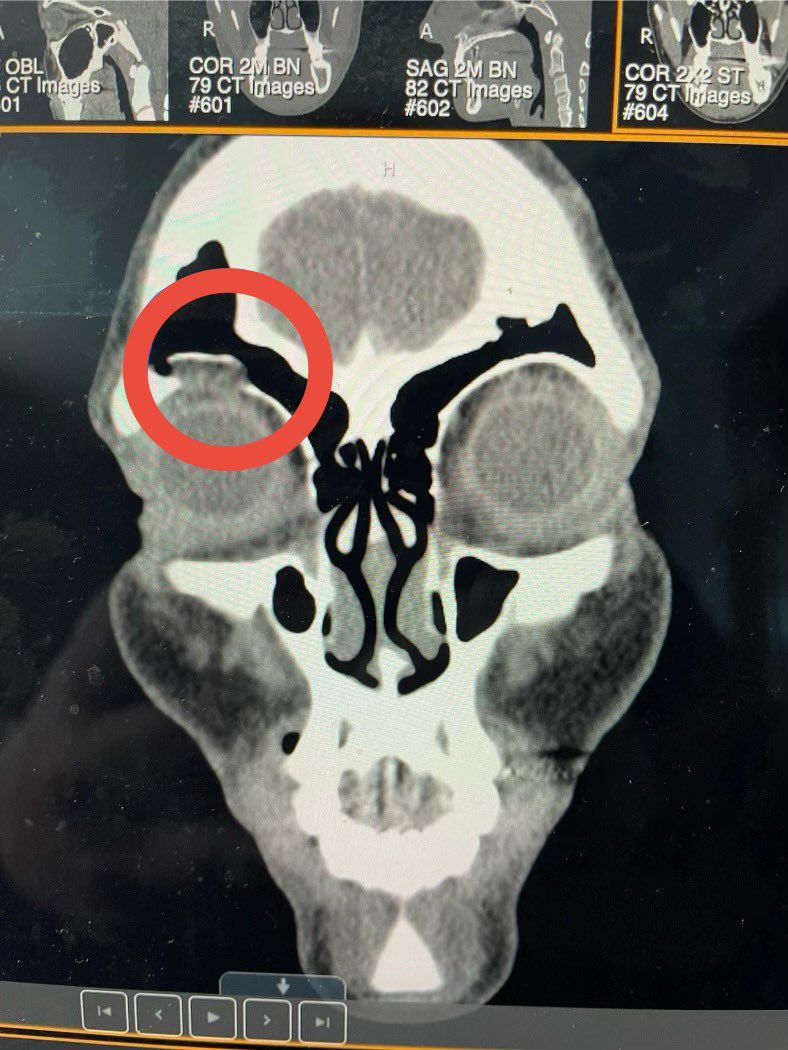 Rhea Ripley fractured right orbital socket X-ray CT Scan - 1