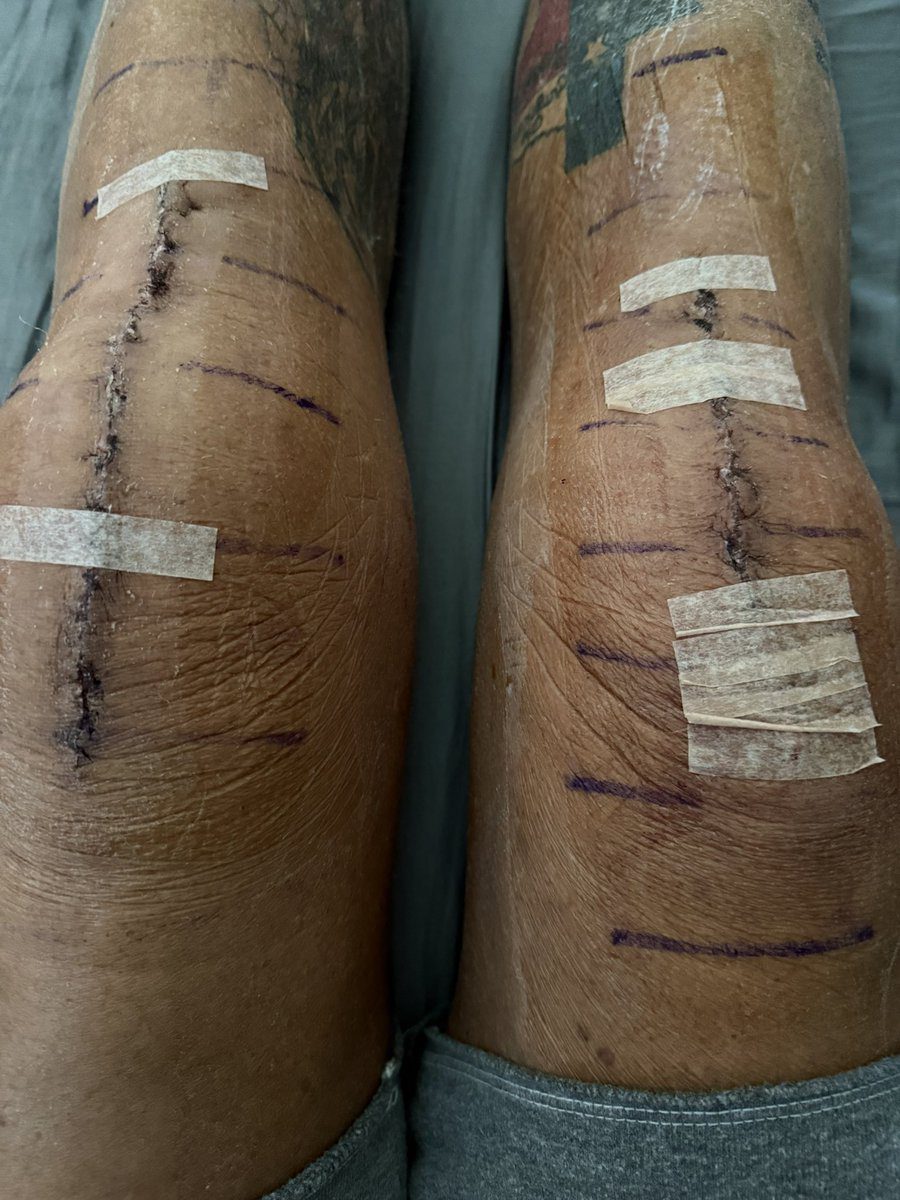 Dustin Rhodes Double Knee Replacement Surgery