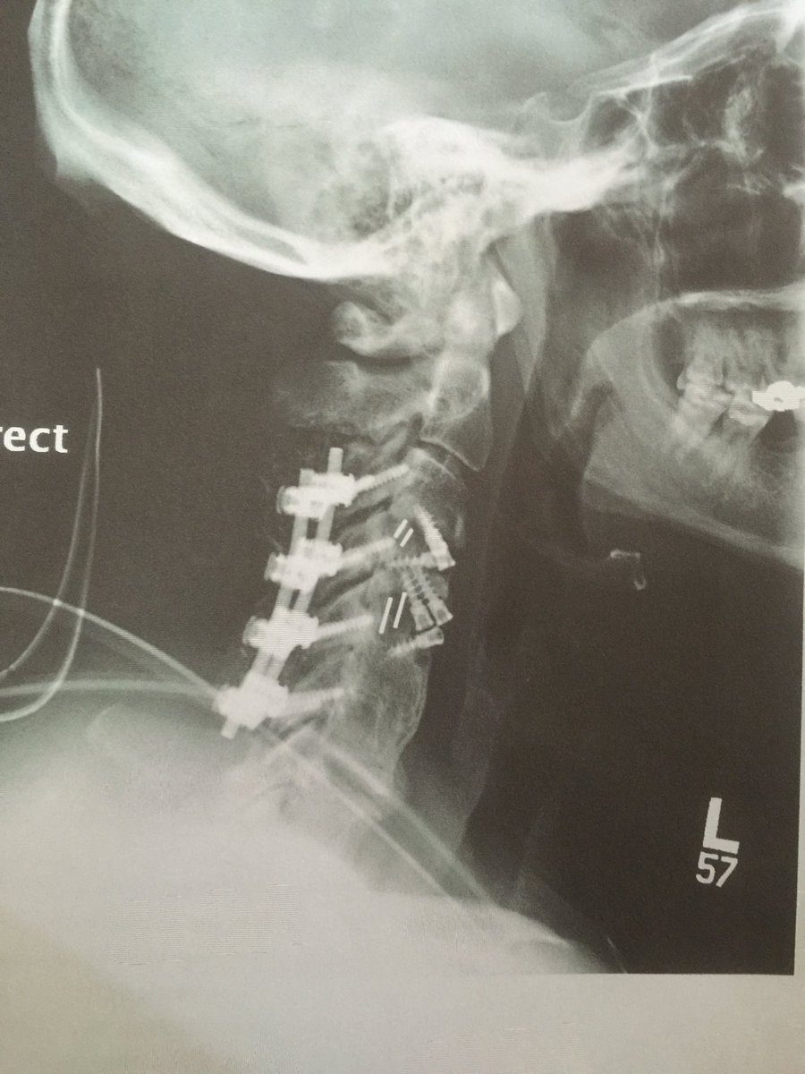 William Regal Broken Neck X-Ray